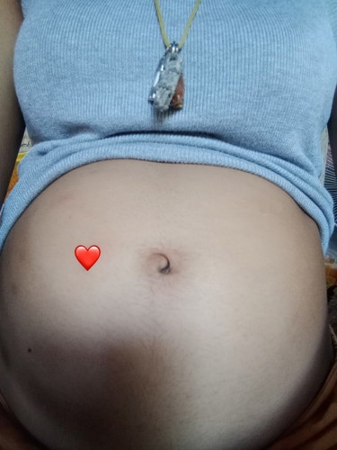 20weekท้องแรก เป็นแฝดมี1รก แฝดเหมือนจ้า