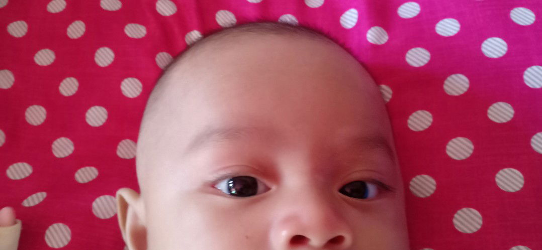 Bercak putih di wajah bayi