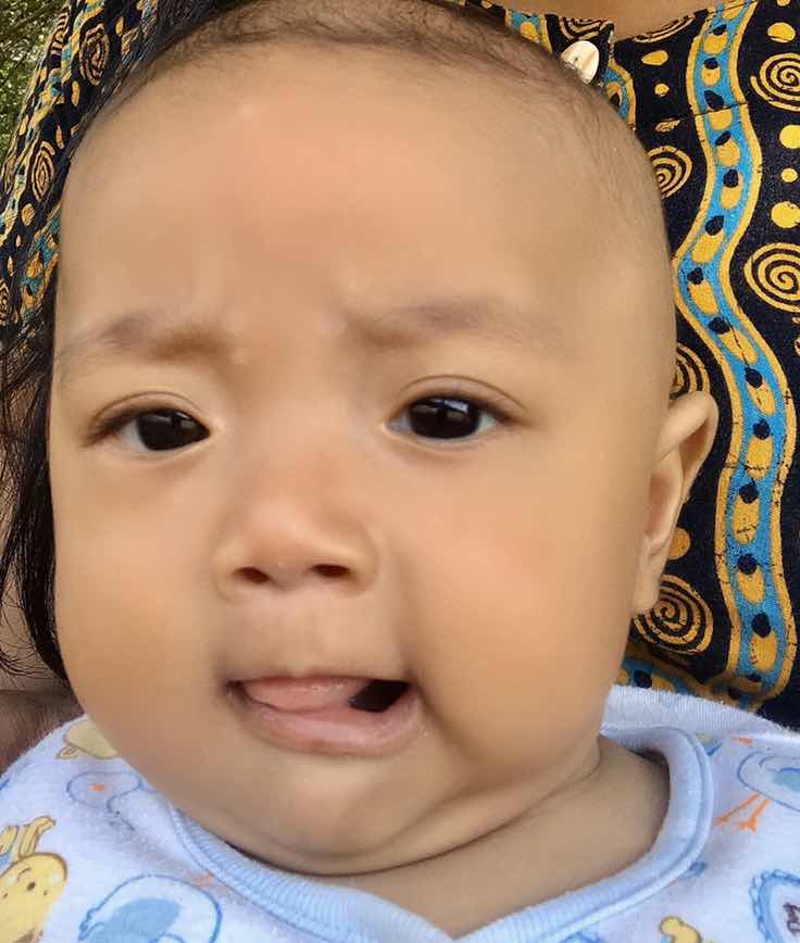 Bercak putih pada wajah bayi