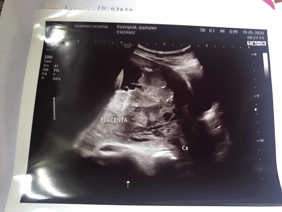 รกเกาะต่ำ ต้องผ่าคลอด 37 สัปดาห์