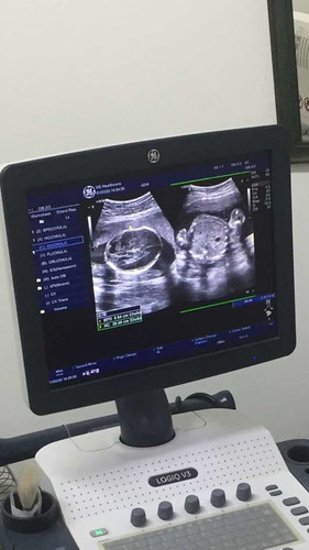 ลูกรักของแม่??23w4d น้องเป็นผู้หญิงค่ะ??