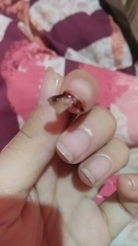 ก้อนเลือด