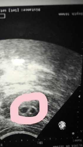 Assalamualaikum ..saya hamil 31weeks 3 days DCDA twins..doakan saya bersalin secara Normal Amin