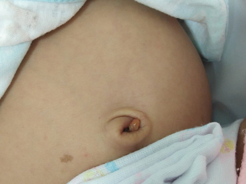 ติ่งเนื้อที่สะดือ