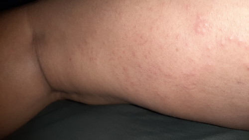 puppp rash