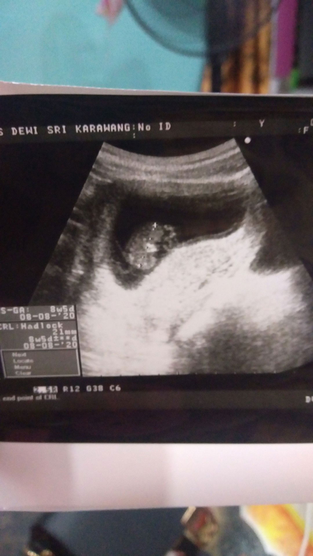 tidak ada detak jantungnya