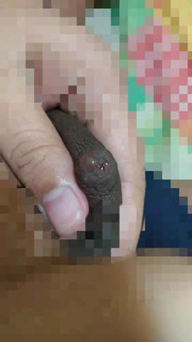 Intraductal Papilloma