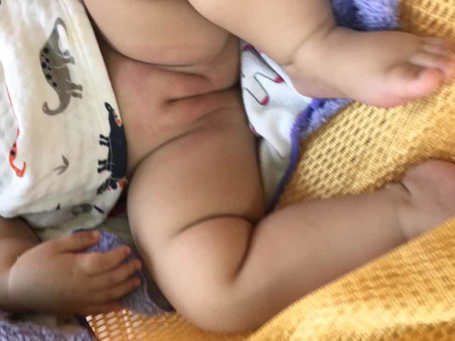 น้องๆบ้านไหนเคยเป็นแบบนี้ไมค่ะ