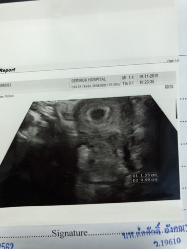 7 week ซาวด์แล้วยังไม่เจอน้องค่ะ?