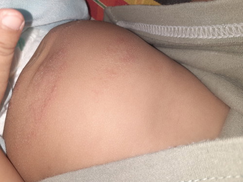 ผื่นเเดงตามท้อง