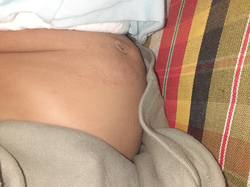 ผื่นเเดง