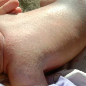 cara mengatasi bintik2 merah