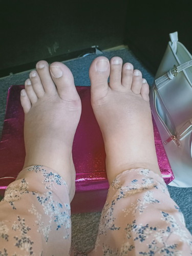 Kaki bengkak
