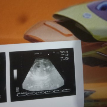 posisi bayi saya sungsang bunda Bb:3200