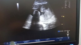 35w2d บ้านนี้ได้ลูกชาย แม่ๆบ้านอื่นรู้เพศน้องกันหรือยังค่ะ