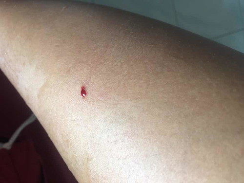 สุนัขกัด