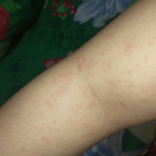 gatal-gatal apakah bawaan bayi?