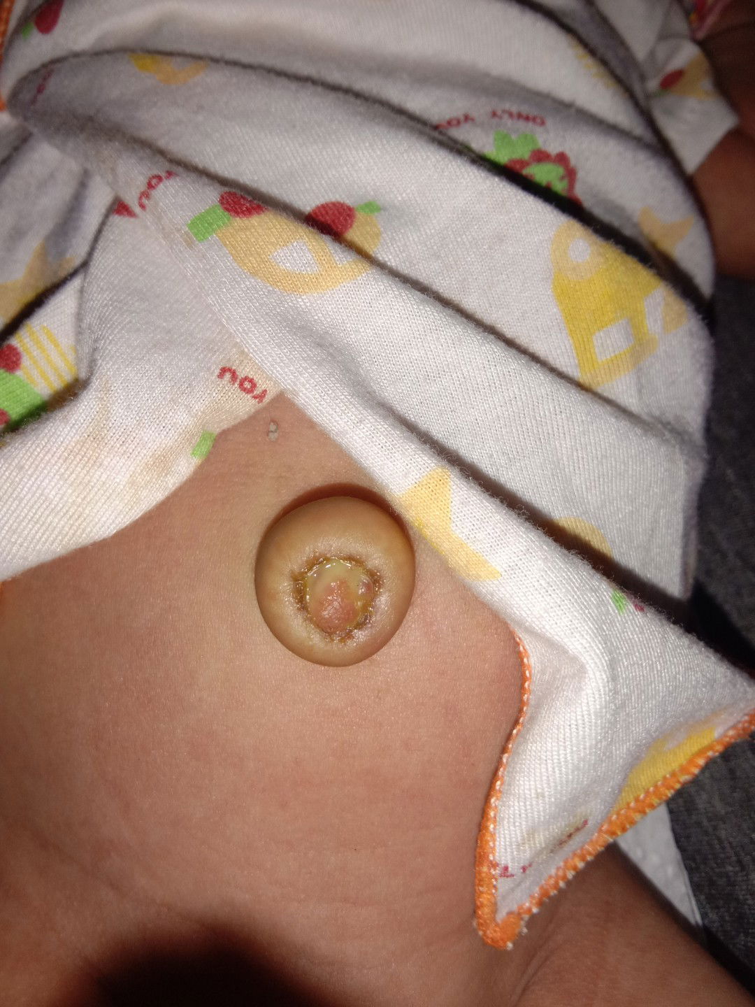 สะดือน้องจะหายมั้ย