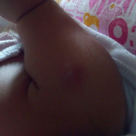 cyst or lump?