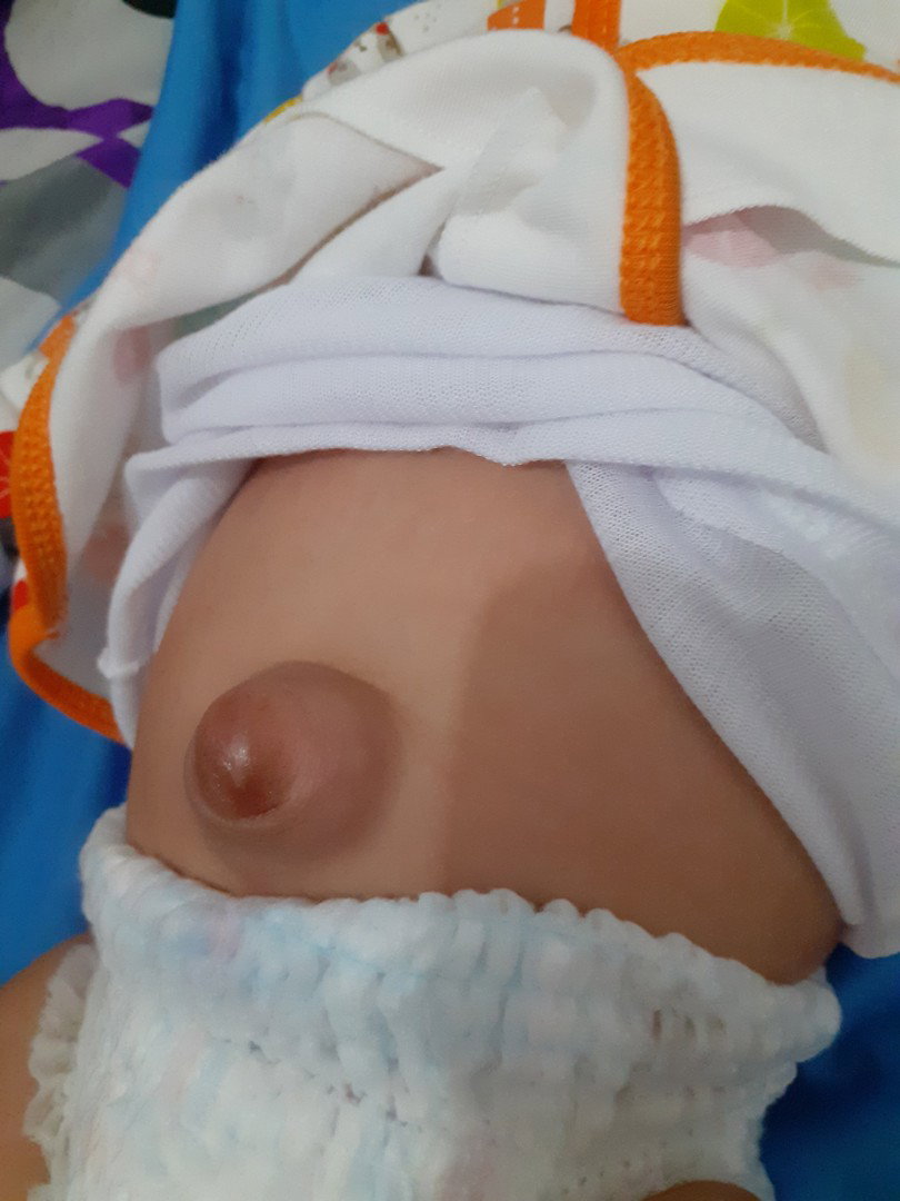 hernia umbilical