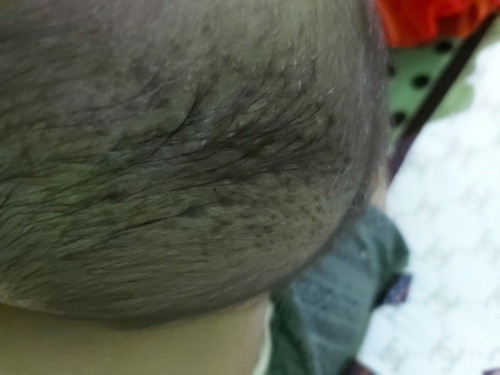 How to remove cradle cap?