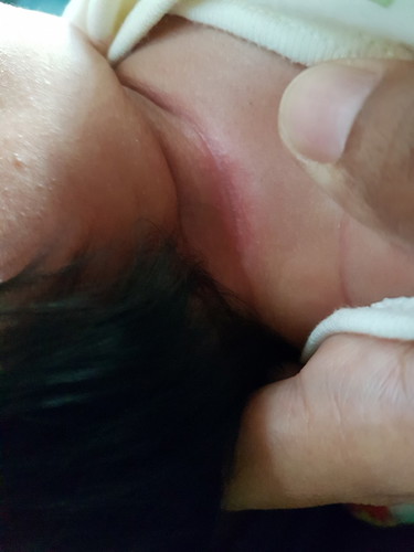 ลูกเป็นเหมือนแผลที่ซอกคอมีกลิ่นด้วยเอาอะไรทาได้บ้าง