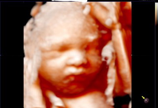 36 weeks gestational diabetes