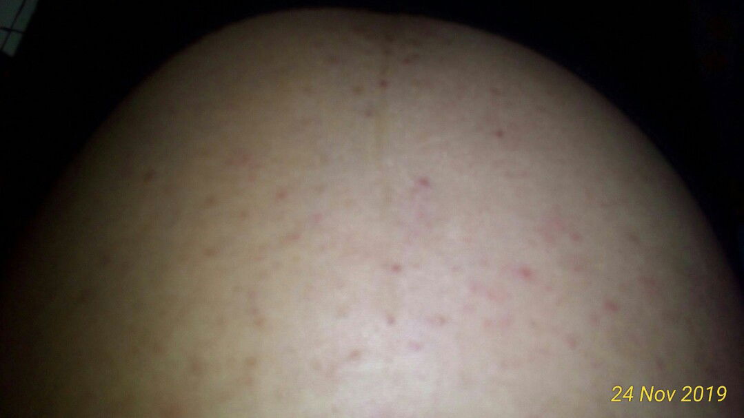 bintik2 merah bruntusan saat hamil