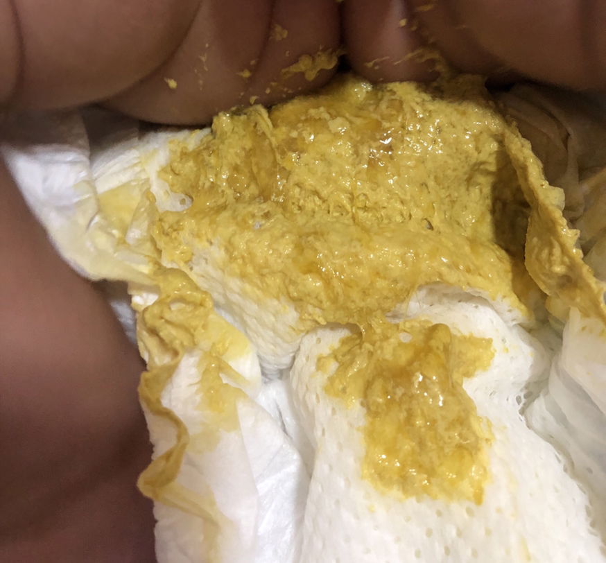 Poops with slimy texture (excuse sa picture)