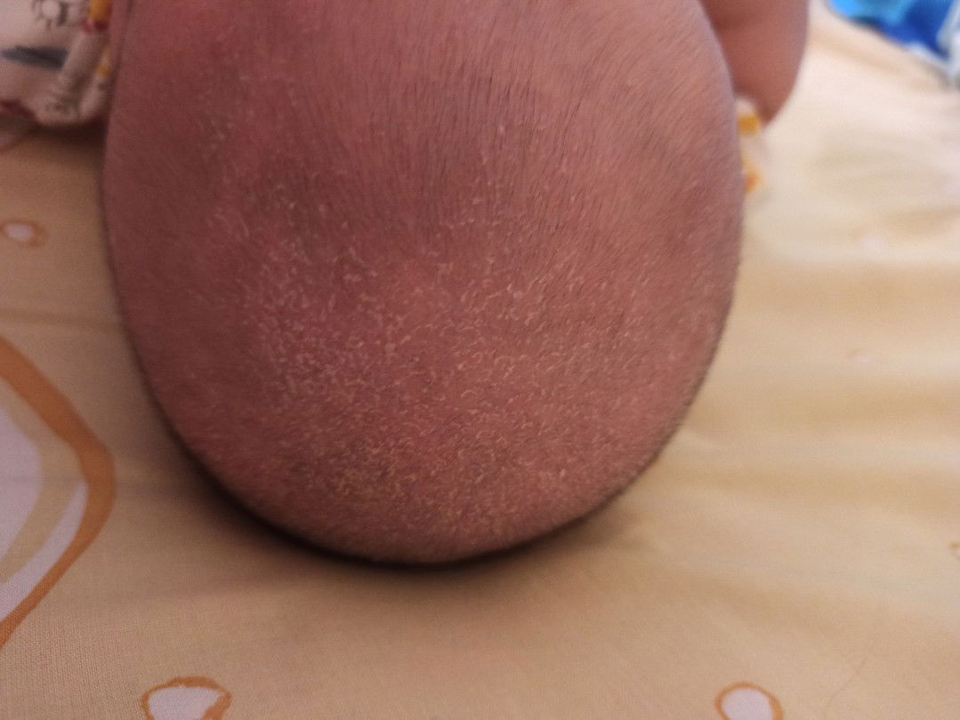 kulit kepala bayi kering