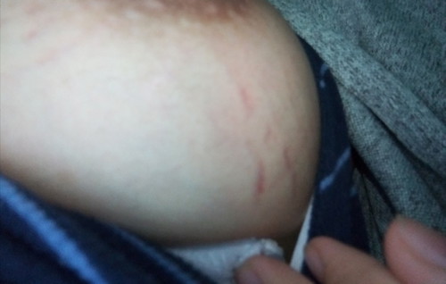 STRETCH MARKS