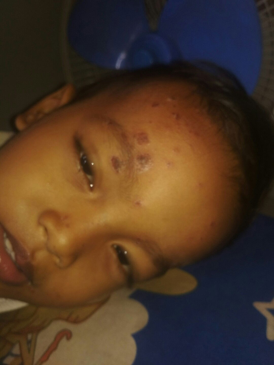 Cacar Tpi Gk Kya Cacar