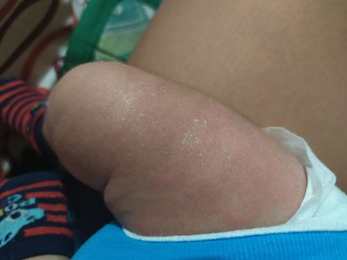 Dry skin, rashes