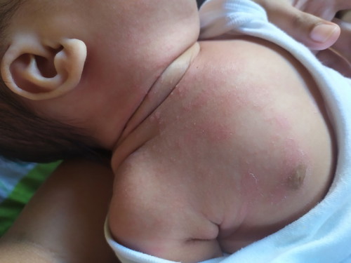 rashes, dry skin