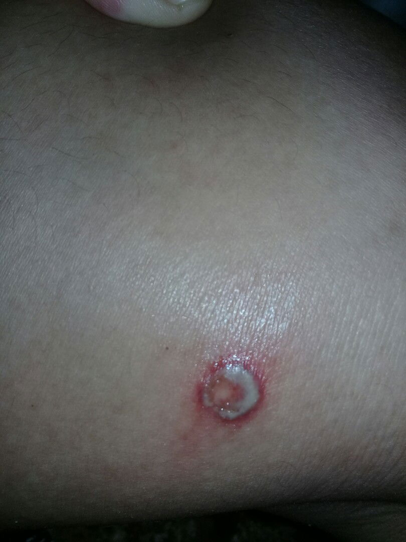 sakit cacar apa bukan