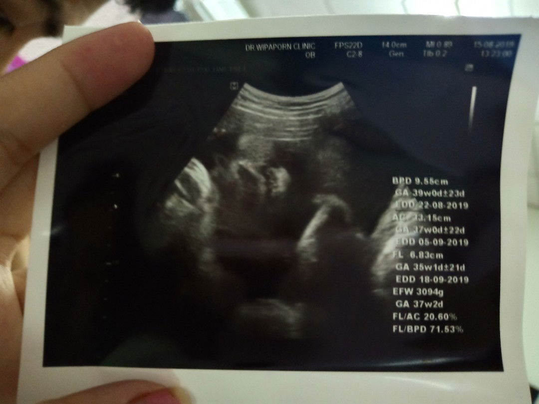 หมอนัดจะเร่งคลอดพอถึงเวลาก็เลื่อน