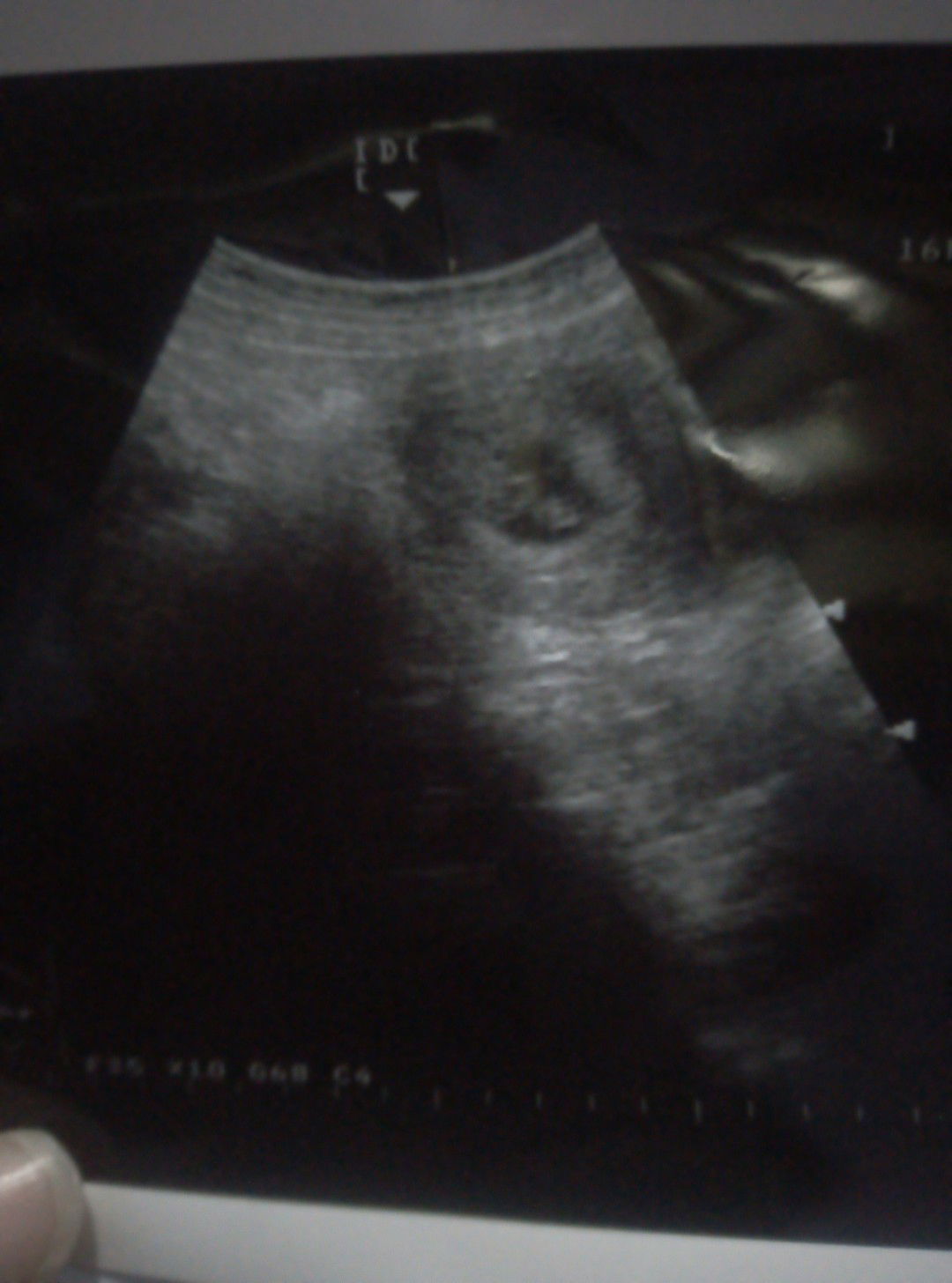 Usg 8 minggu