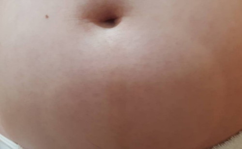 ท้องนูนเป็นวงกลมใต้สะดือ