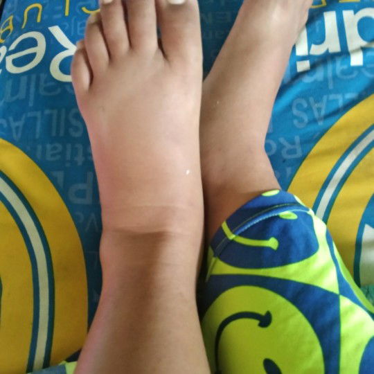 kaki bengkak