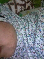 berjerawat semenjak hamil