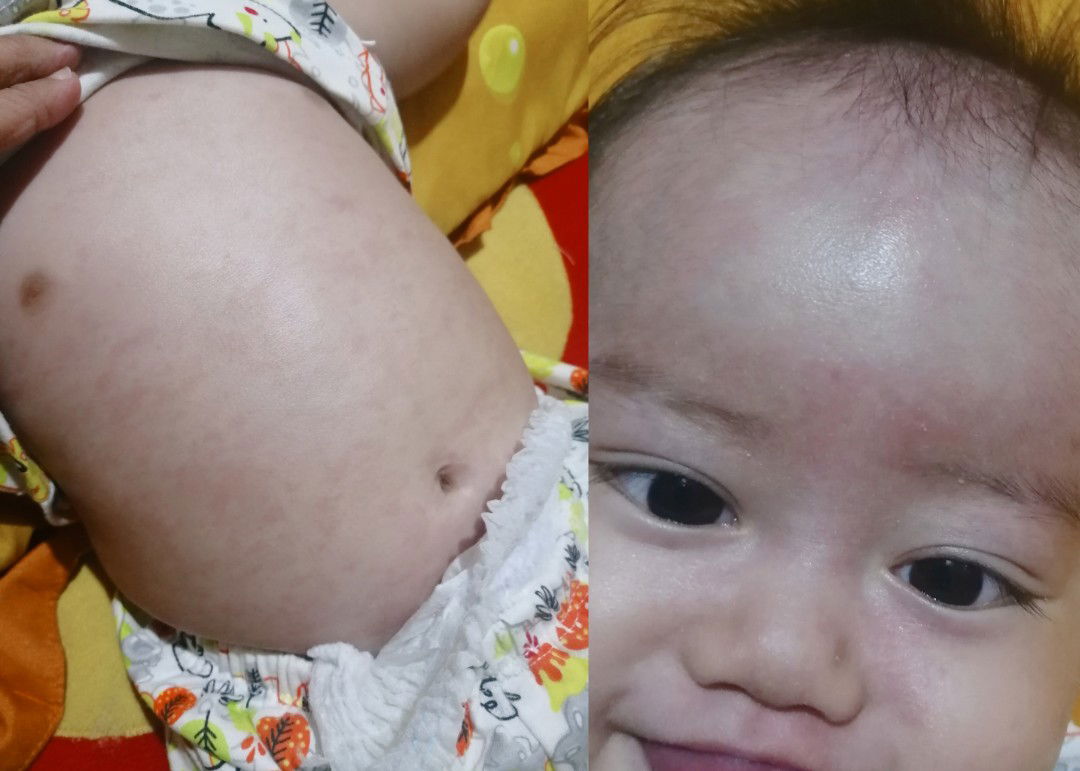 Kemerahan Setelah Demam