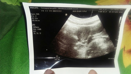 hasil usg