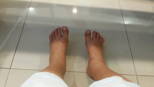 เท้าบวม