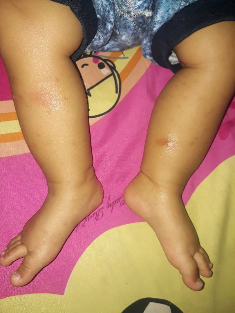 Bekas gigitan nyamuk