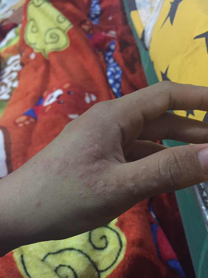Tangan gatel