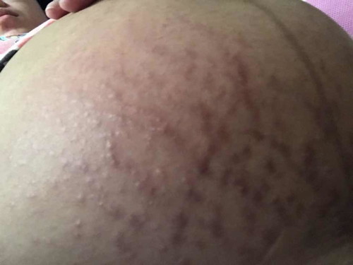 Stretch Marks