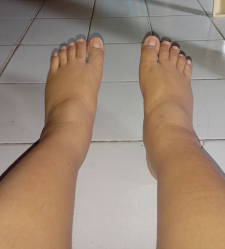 Home Treatment/Remedy