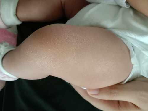 Dryness of baby's skin