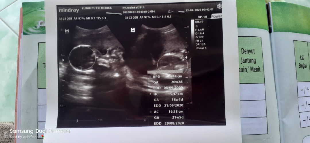 k2 X nya USG tp jk blm keliatan