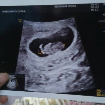 9w sudah ada detak jantung